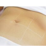 Fotona Tight Sculpting