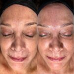 hydrafacial for acne