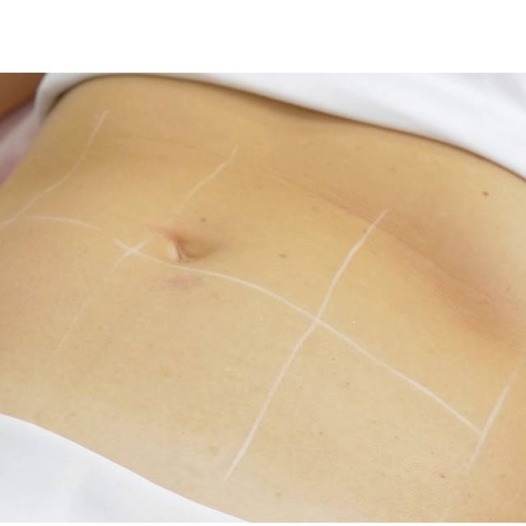 Fotona Tight Sculpting