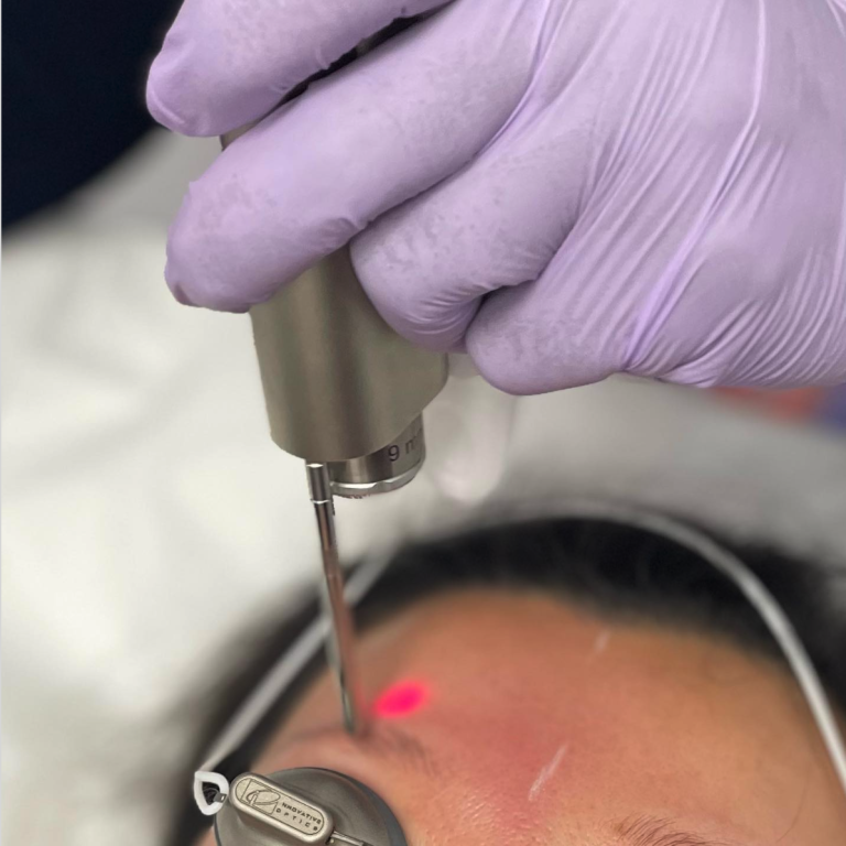 Stubborn fat and loose skin around laugh lines and blur facial contours and make the lower face appear heavier or aged. At En Santé Med, Endolift® / EndoTight™ offers a powerful, minimally invasive laser solution to reduce fat, tighten skin, and redefine the jawline—without surgery, scars, or extended downtime. This advanced treatment delivers natural, progressive results using precision laser technology beneath the skin.